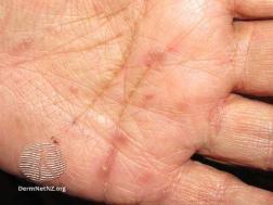 scabies palm 2